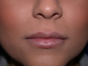 Lip Augmentation After