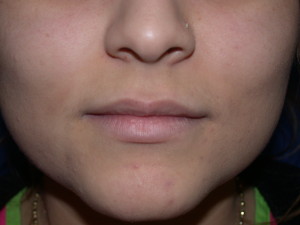 Lip Augmentation Before